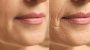  Laser Face Lift