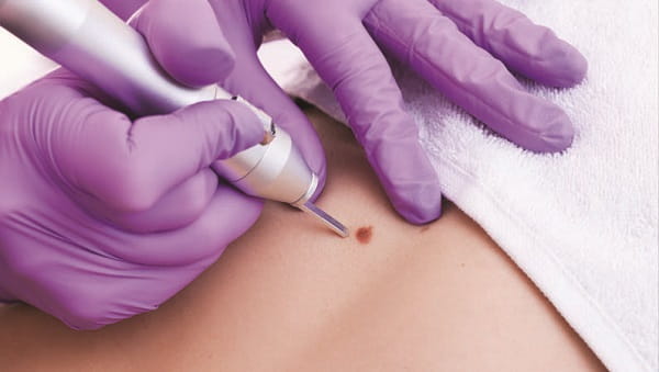 Mole Removal without scar, painless and safe | Laven Clinic