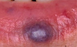 Vascular Spots