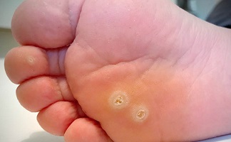  Warts