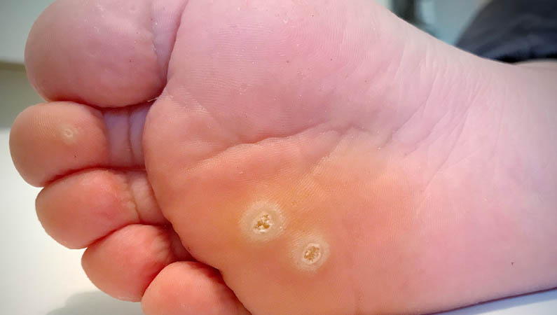 Hpv warts on feet and hands, Hpv wart foot