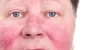  Facial Veins