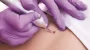  Scarless Mole Removal