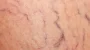  Spider Veins