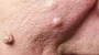  Moles, Cysts, Skin tags